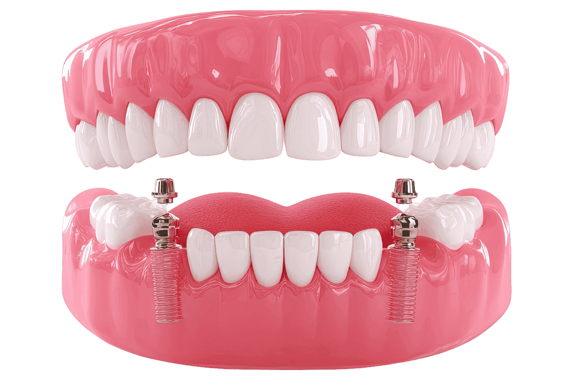 SAP Dental Laboratory — Implant Dentures